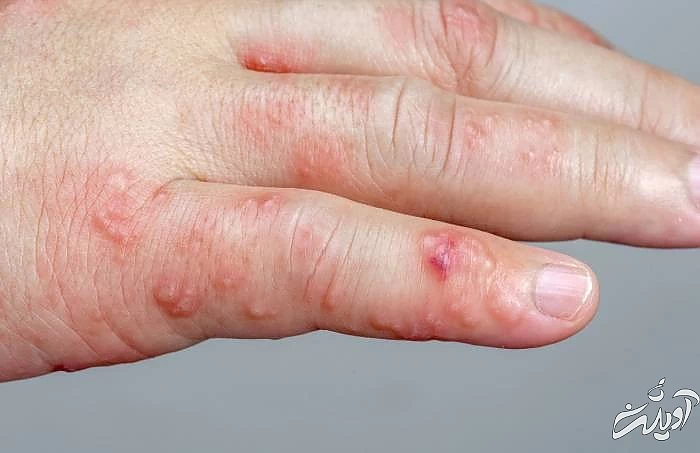 سوزن شدن یا بی حسی دست با زونا زونا